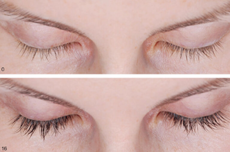 KLS Aesthetics LATISSE®